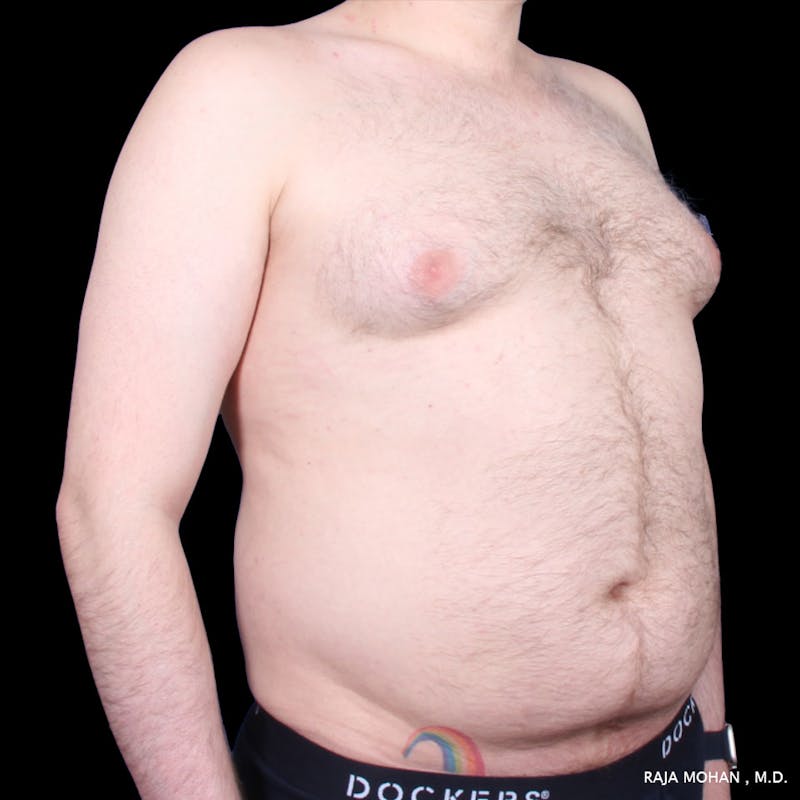 Liposuction Before & After Gallery - Patient 100759 - Image 59