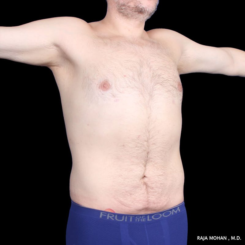 Liposuction Before & After Gallery - Patient 100759 - Image 60