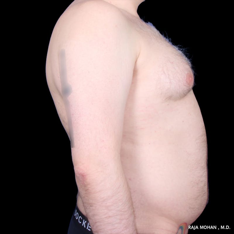Liposuction Before & After Gallery - Patient 100759 - Image 61
