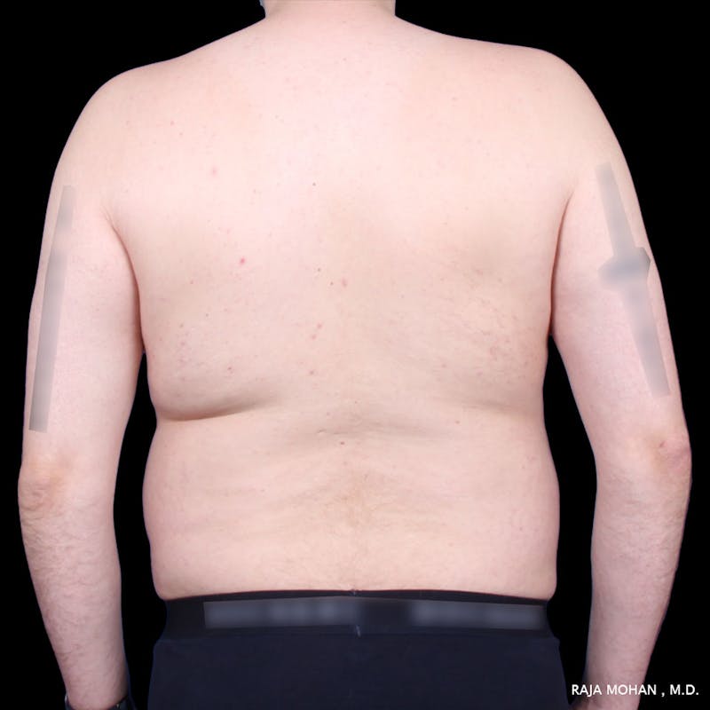 Liposuction Before & After Gallery - Patient 100759 - Image 63