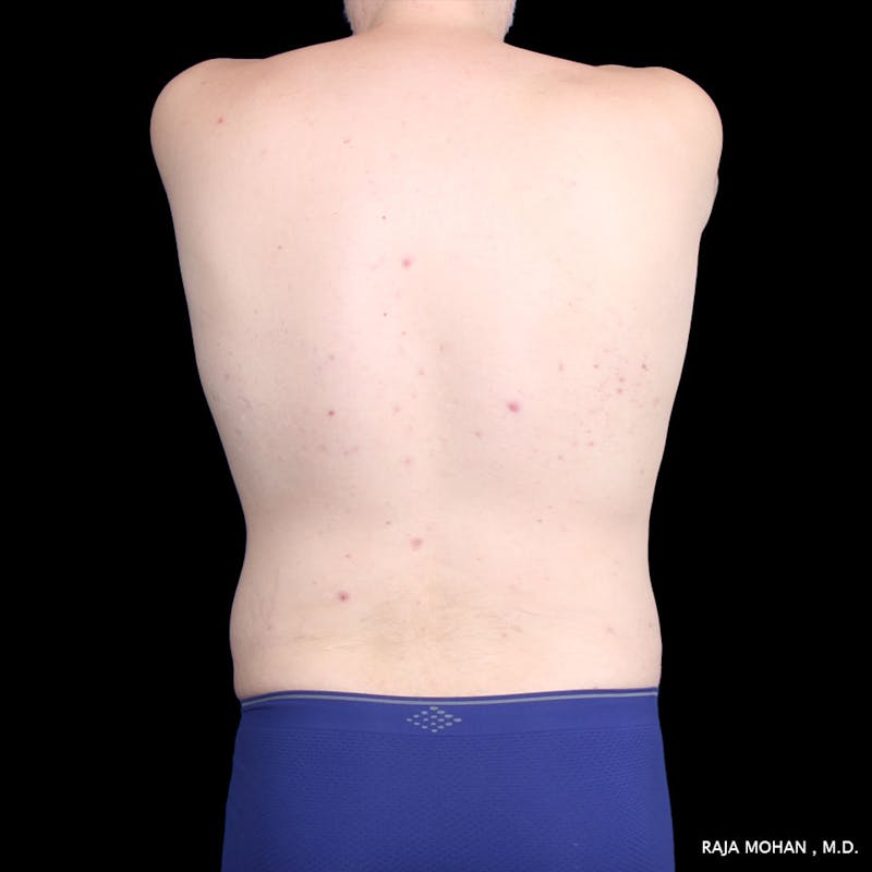 Liposuction Before & After Gallery - Patient 100759 - Image 64