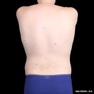 Liposuction Before & After Gallery - Patient 100759 - Image 64