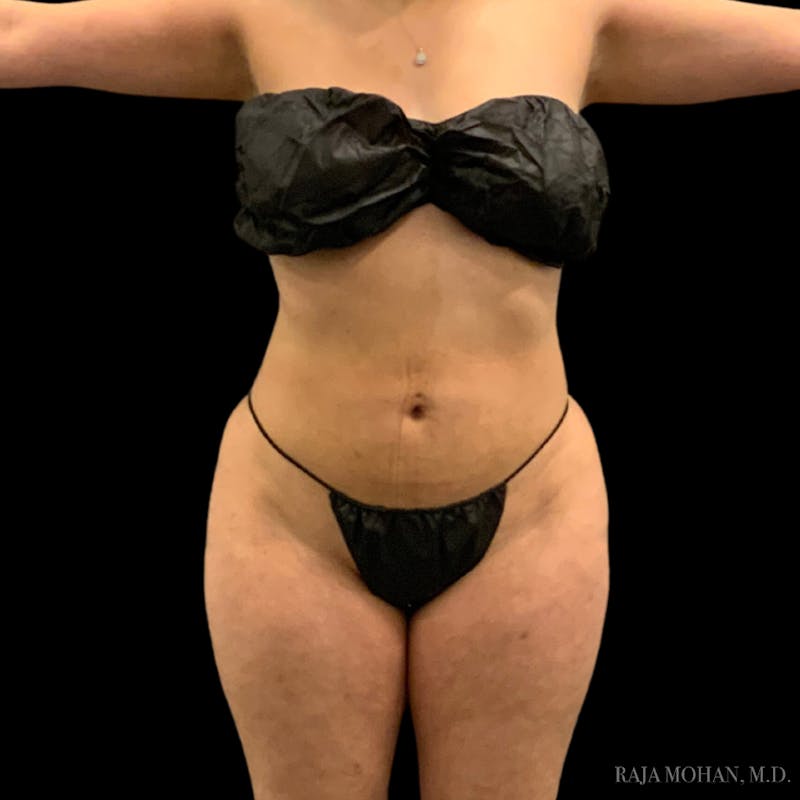 Liposuction Before & After Gallery - Patient 100759 - Image 66