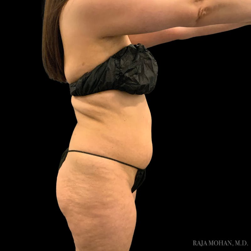 Liposuction Before & After Gallery - Patient 100759 - Image 69