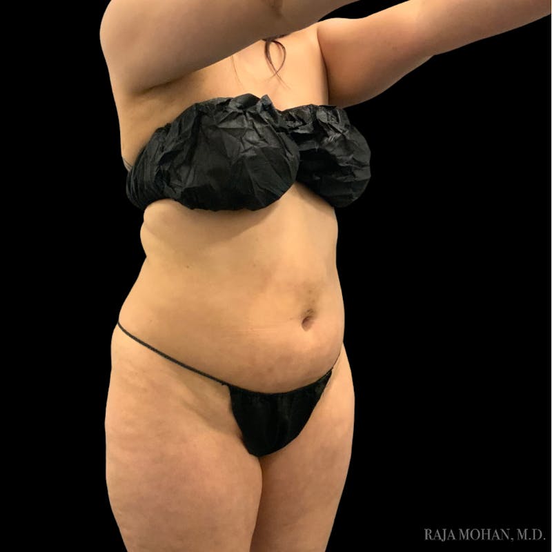 Liposuction Before & After Gallery - Patient 100759 - Image 71