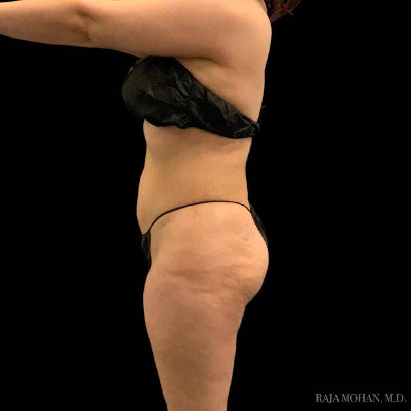 Liposuction Before & After Gallery - Patient 100759 - Image 74