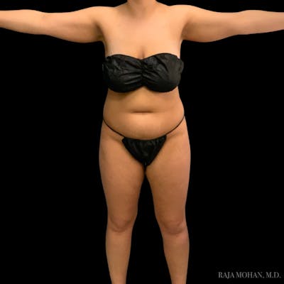 Liposuction Before & After Gallery - Patient 343567 - Image 1