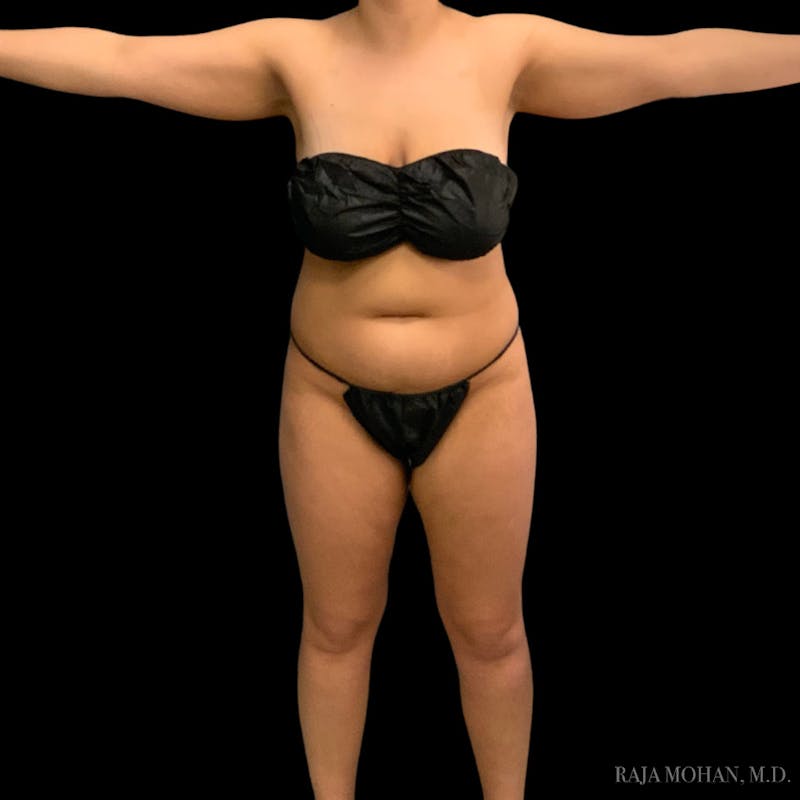 Liposuction Before & After Gallery - Patient 100759 - Image 77