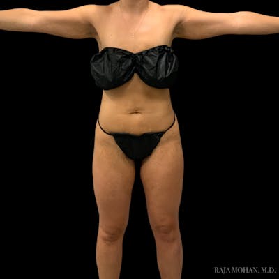 Liposuction Before & After Gallery - Patient 343567 - Image 2