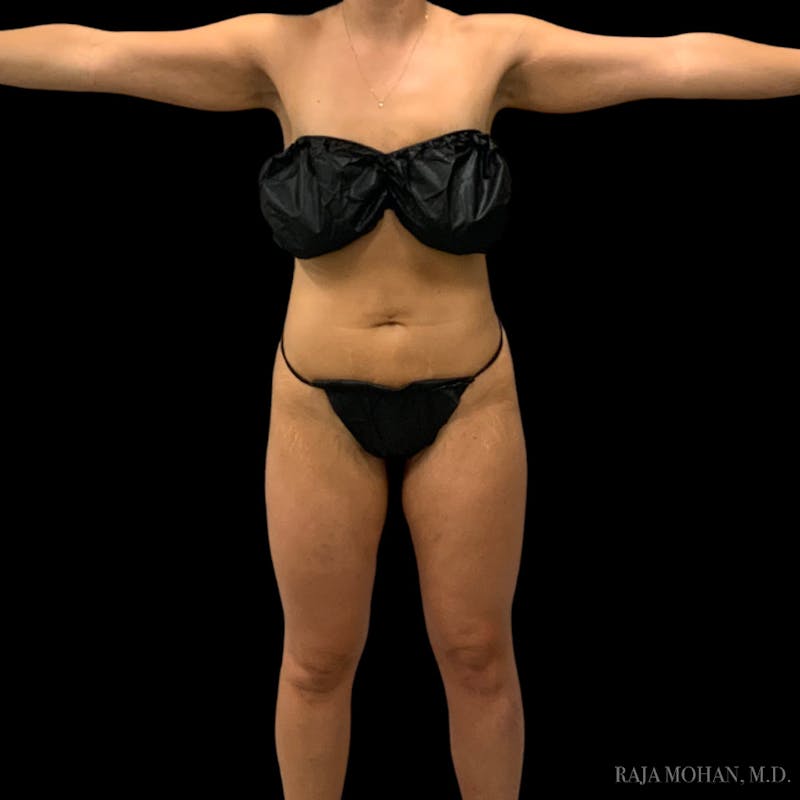 Liposuction Before & After Gallery - Patient 100759 - Image 78