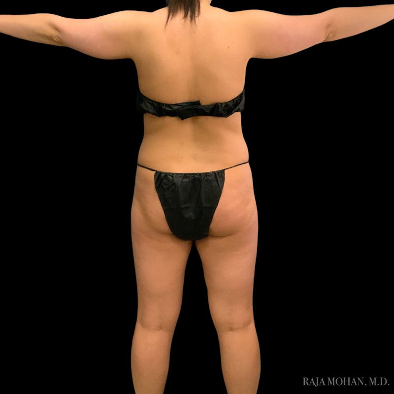 Liposuction Before & After Gallery - Patient 100759 - Image 79
