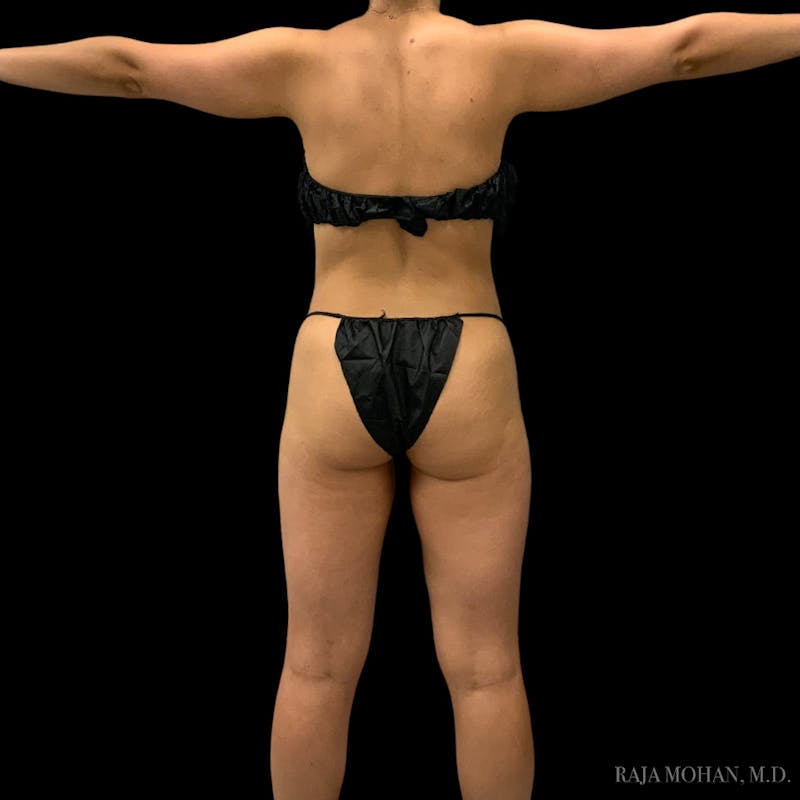 Liposuction Before & After Gallery - Patient 100759 - Image 80