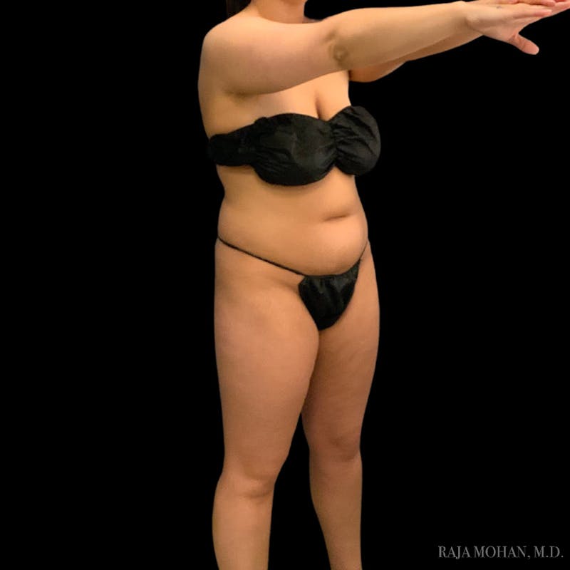 Liposuction Before & After Gallery - Patient 100759 - Image 83