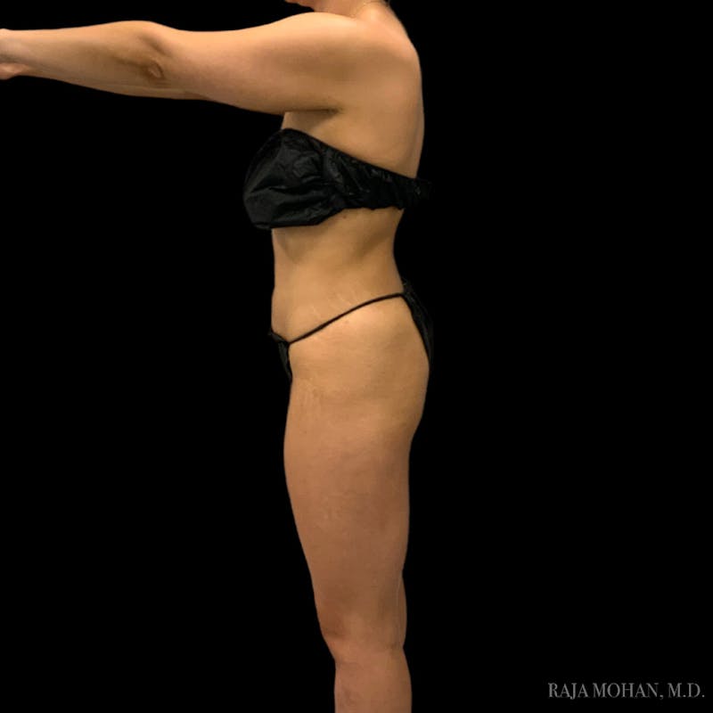 Liposuction Before & After Gallery - Patient 100759 - Image 86