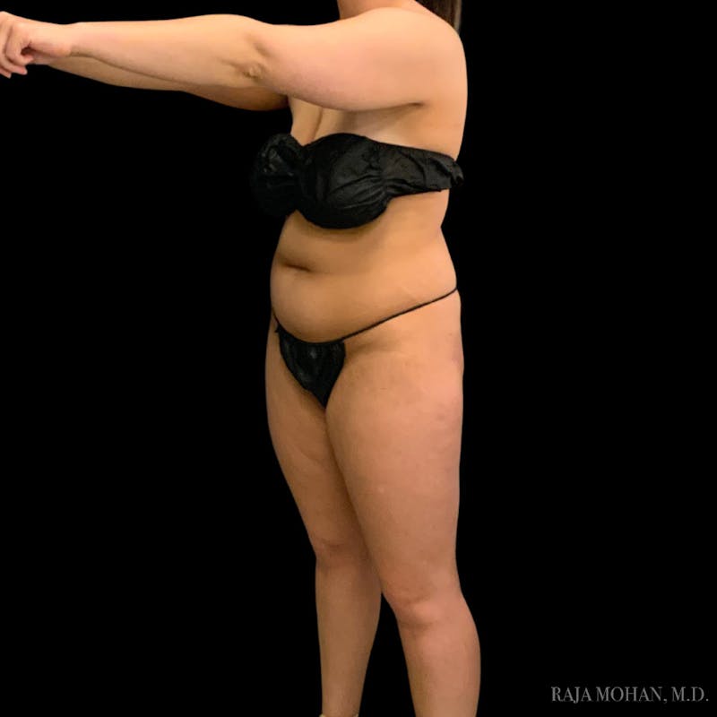 Liposuction Before & After Gallery - Patient 100759 - Image 87
