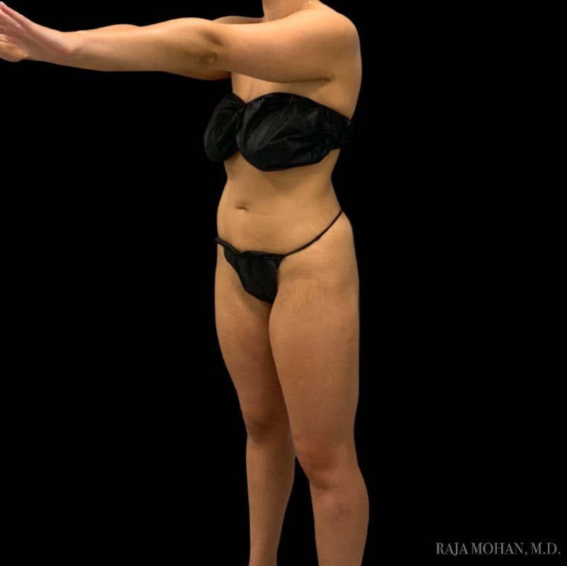 Liposuction Before & After Gallery - Patient 100759 - Image 88
