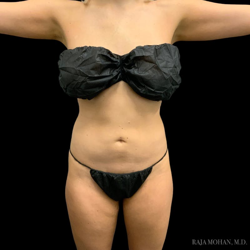 Liposuction Before & After Gallery - Patient 100759 - Image 90