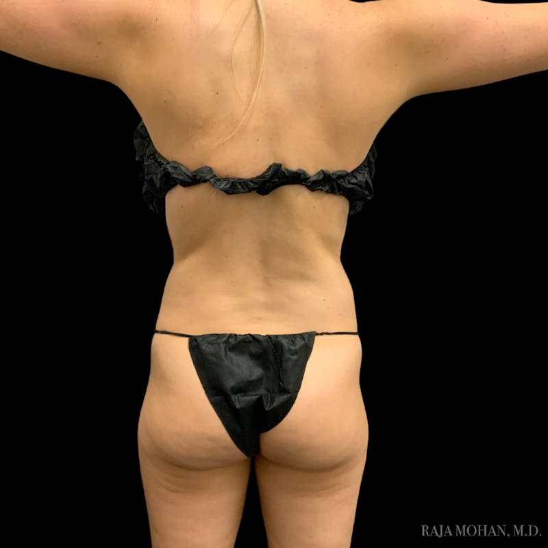 Liposuction Before & After Gallery - Patient 100759 - Image 92