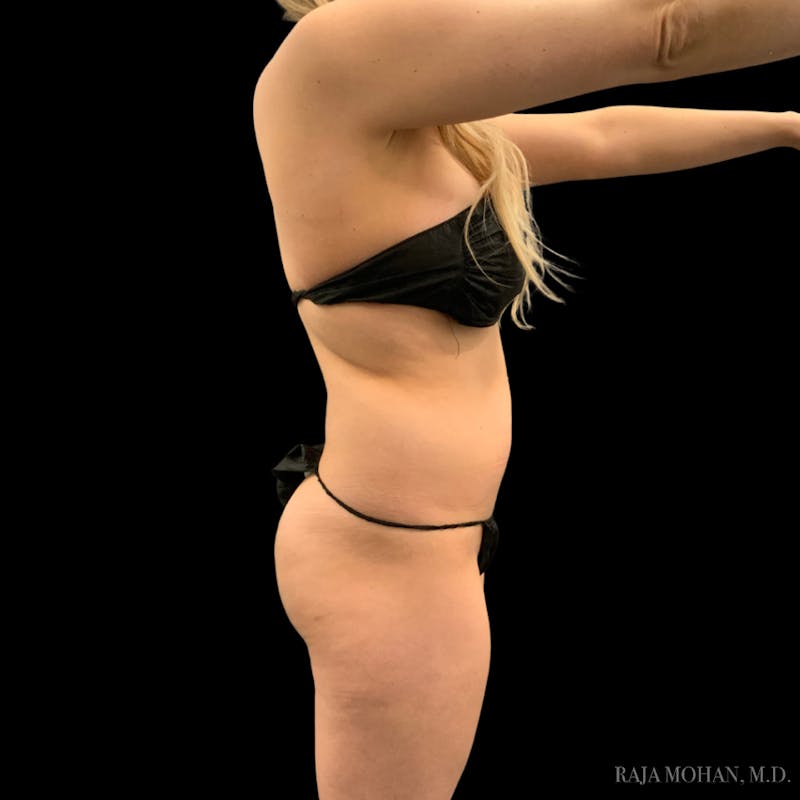 Liposuction Before & After Gallery - Patient 100759 - Image 93
