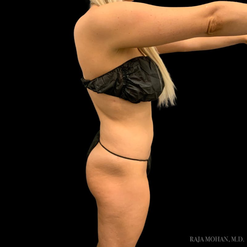Liposuction Before & After Gallery - Patient 100759 - Image 94