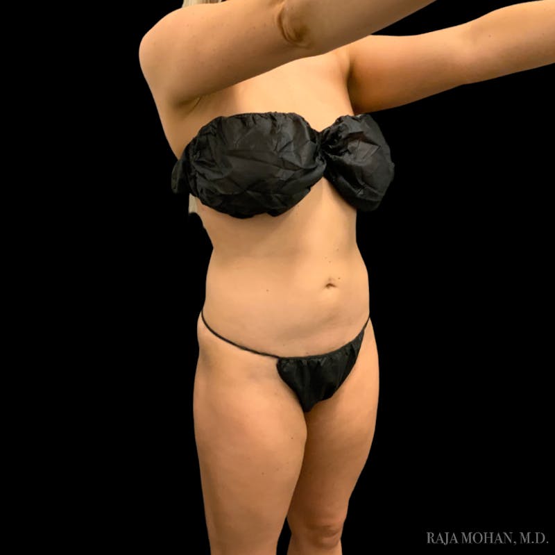 Liposuction Before & After Gallery - Patient 100759 - Image 96