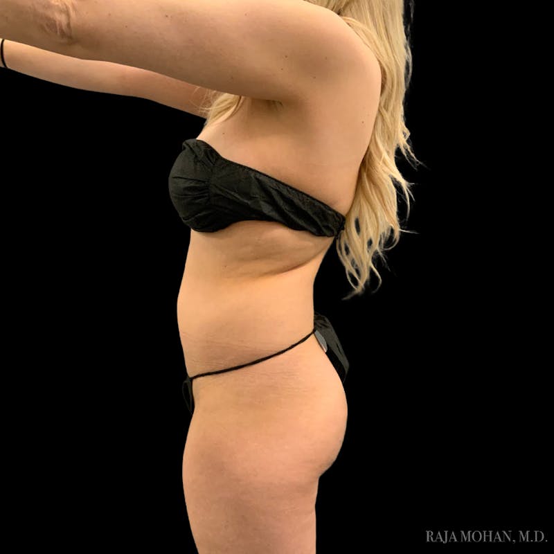 Liposuction Before & After Gallery - Patient 100759 - Image 97
