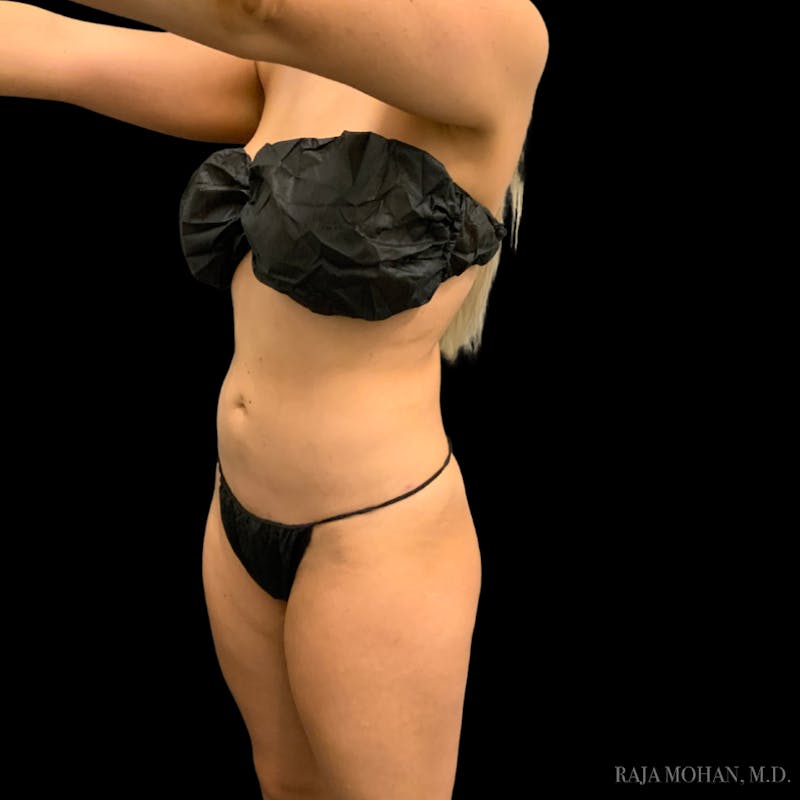 Liposuction Before & After Gallery - Patient 100759 - Image 100
