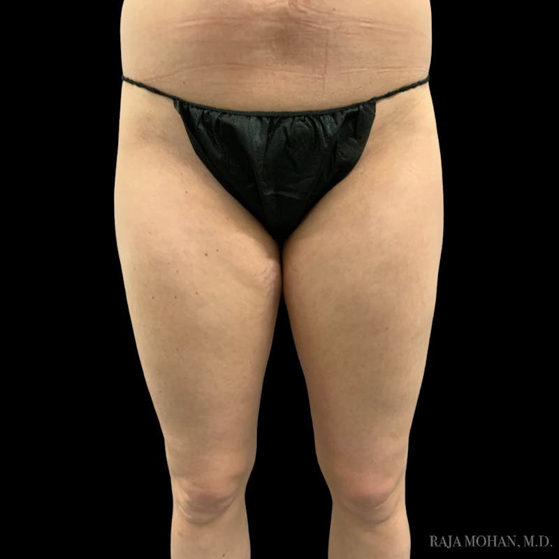 Liposuction Before & After Gallery - Patient 100759 - Image 101