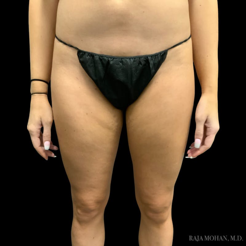 Liposuction Before & After Gallery - Patient 100759 - Image 102