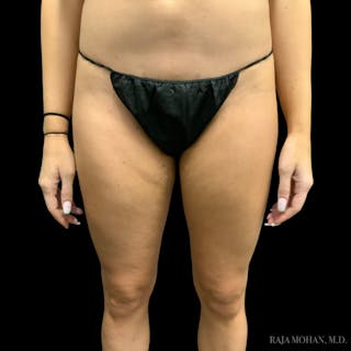 Liposuction Before & After Gallery - Patient 100759 - Image 102