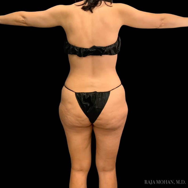 Liposuction Before & After Gallery - Patient 100759 - Image 105