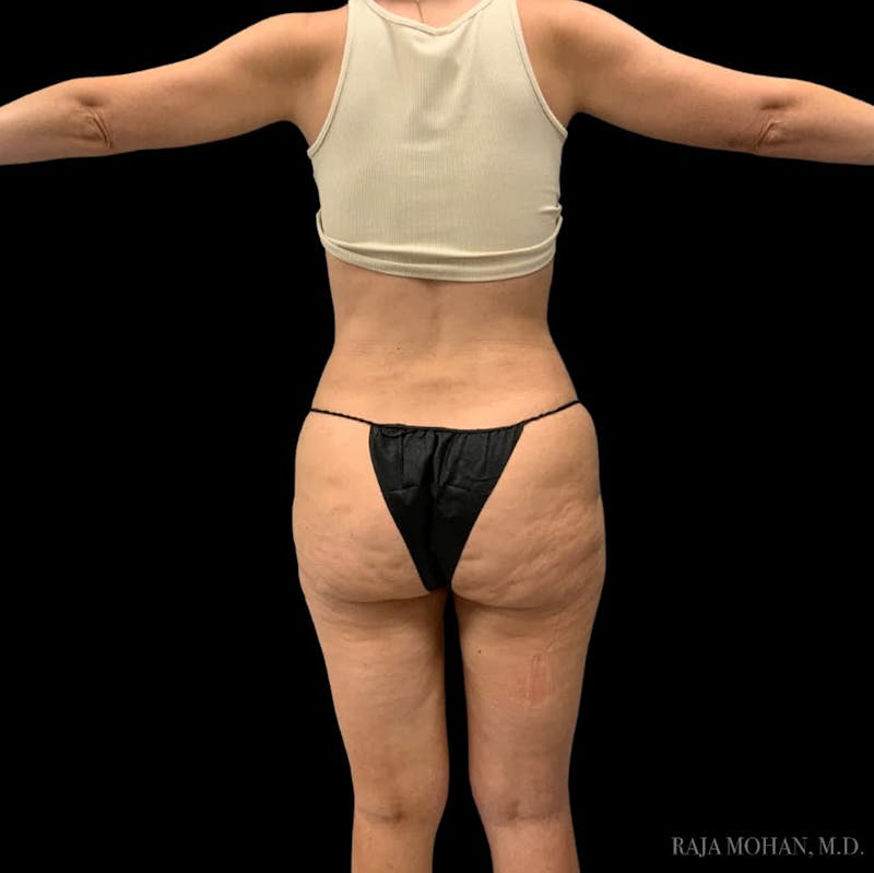 Liposuction Before & After Gallery - Patient 100759 - Image 106