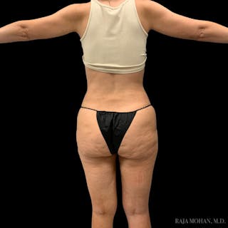 Liposuction Before & After Gallery - Patient 100759 - Image 106