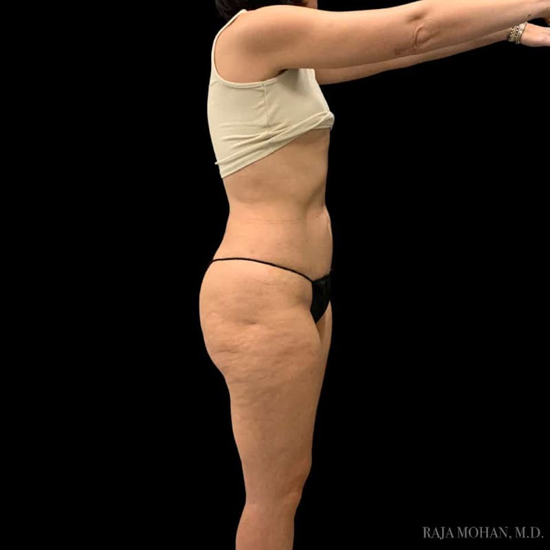 Liposuction Before & After Gallery - Patient 100759 - Image 108