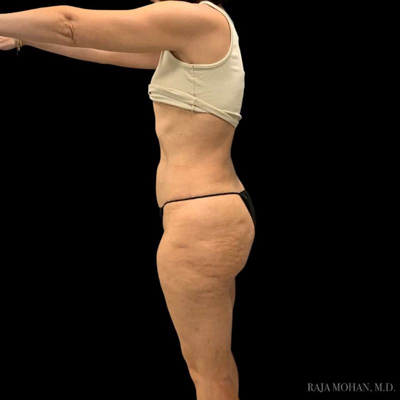 Liposuction Before & After Gallery - Patient 100759 - Image 112