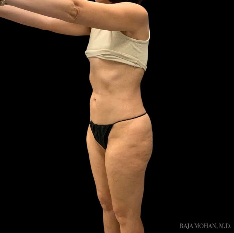 Liposuction Before & After Gallery - Patient 100759 - Image 114