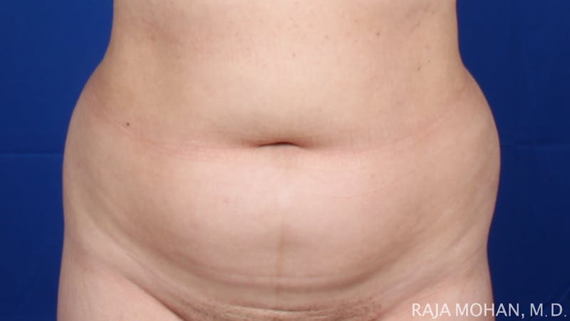 Liposuction Before & After Gallery - Patient 100759 - Image 115