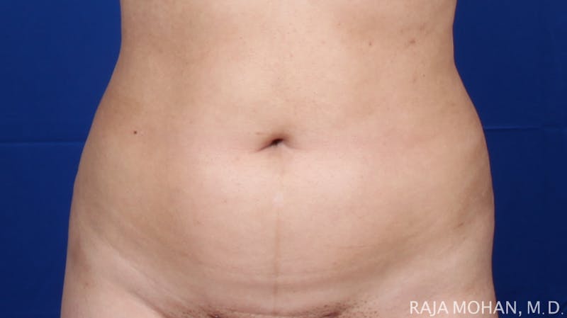 Liposuction Before & After Gallery - Patient 100759 - Image 116