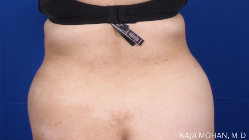 Liposuction Before & After Gallery - Patient 100759 - Image 117