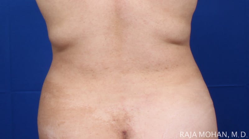 Liposuction Before & After Gallery - Patient 100759 - Image 118