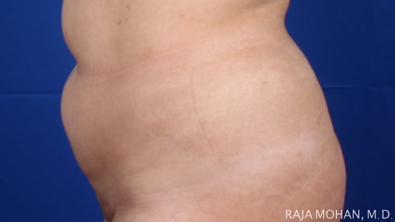 Liposuction Before & After Gallery - Patient 100759 - Image 119