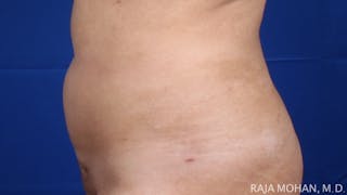 Liposuction Before & After Gallery - Patient 100759 - Image 120
