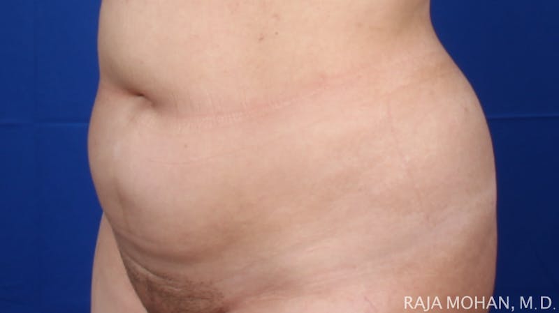 Liposuction Before & After Gallery - Patient 100759 - Image 121