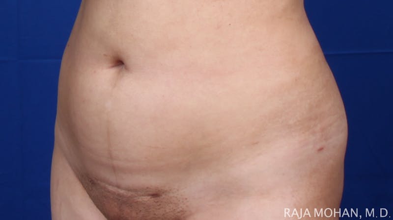 Liposuction Before & After Gallery - Patient 100759 - Image 122