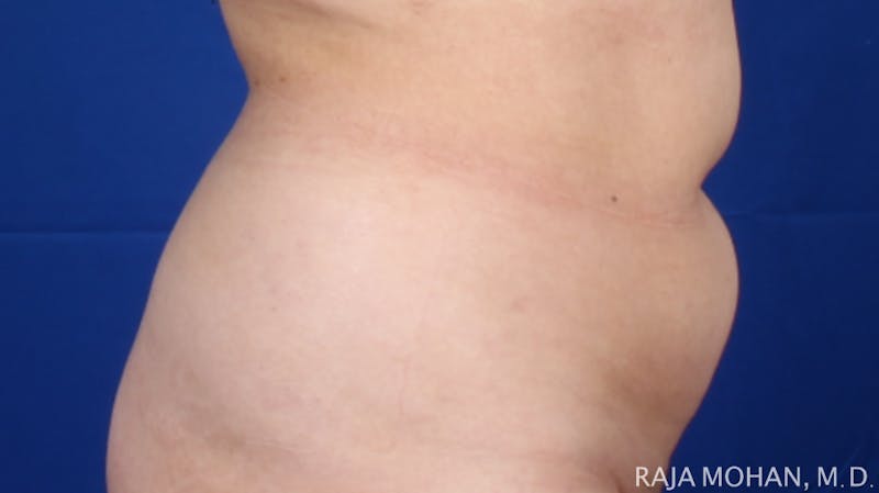 Liposuction Before & After Gallery - Patient 100759 - Image 123