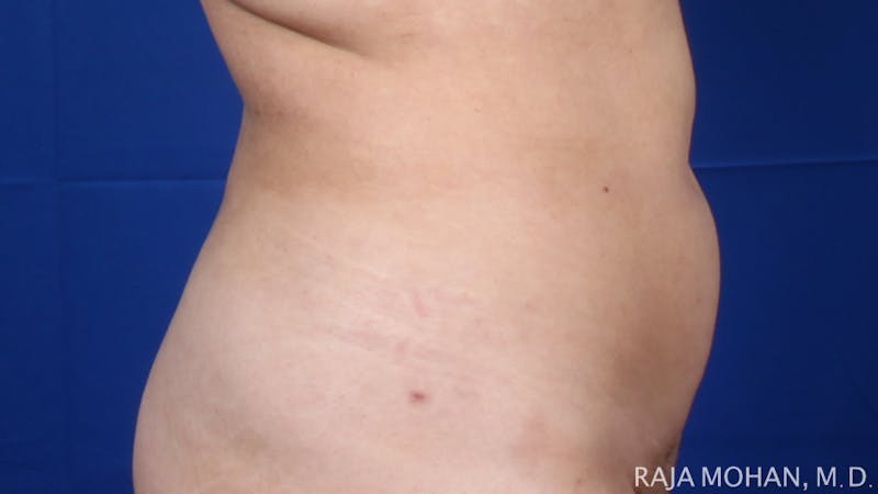 Liposuction Before & After Gallery - Patient 100759 - Image 124