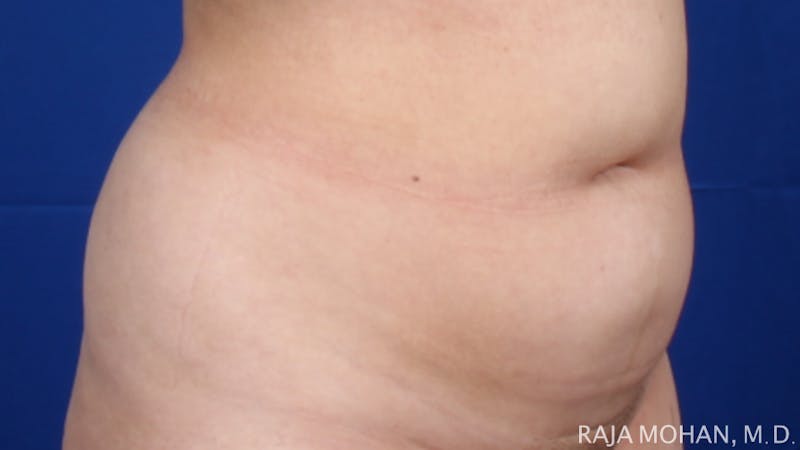 Liposuction Before & After Gallery - Patient 100759 - Image 125