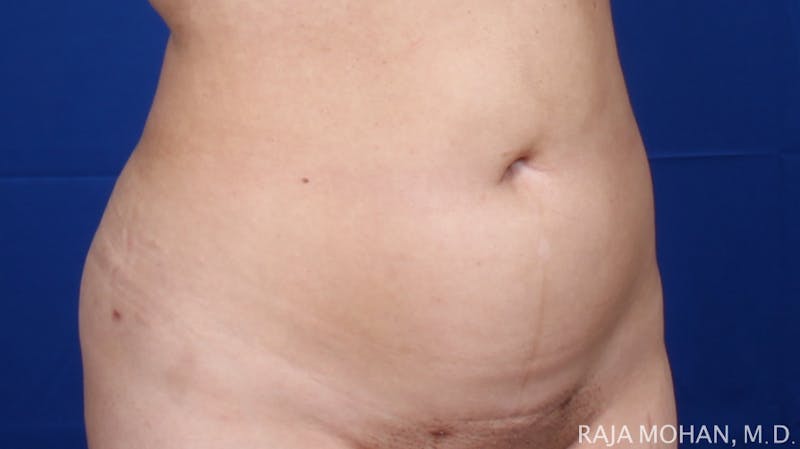 Liposuction Before & After Gallery - Patient 100759 - Image 126