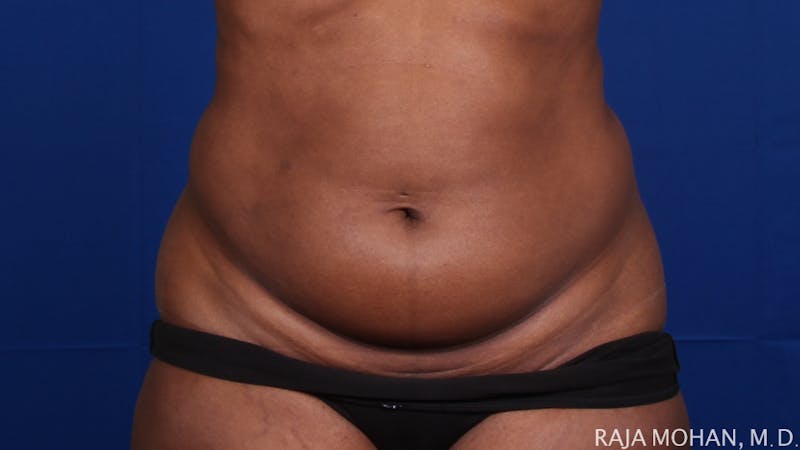 Liposuction Before & After Gallery - Patient 100759 - Image 127