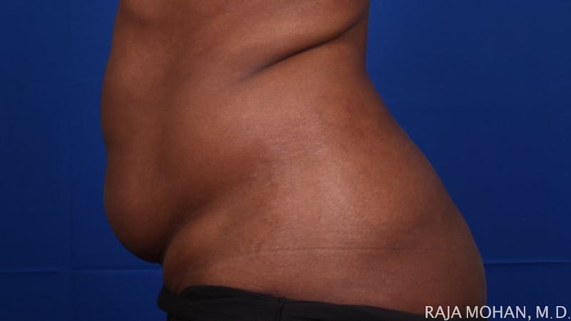 Liposuction Before & After Gallery - Patient 100759 - Image 129